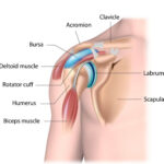 What Are the Best Treatments for Shoulder Impingement?