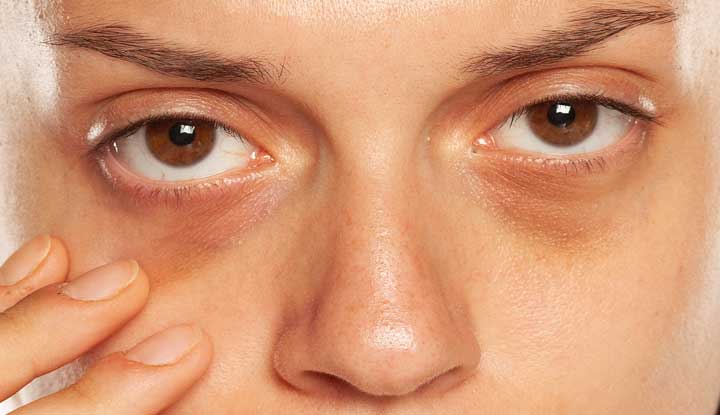 What are the Most Popular Treatments for Dark Eye Circles in Singapore?