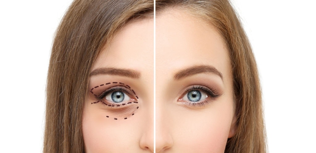 Bright Eyes, No Surgery: The Secret to Non-Surgical Upper Eyelid Lifts