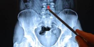 What Imaging Reveals and What It Doesn’t in Spine Diagnosis: Insights from Dr. Larry Davidson