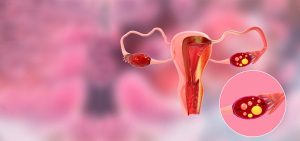 8 Questions to Ask Before Agreeing to Gynaecological Cancer Surgery